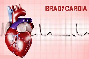Heart rate alterations: bradycardia | Emergency Live