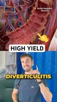 High yield diverticulitis facts for your medical exams
