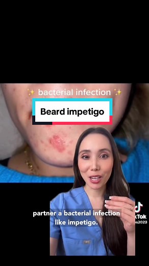 Skin Care Tips for Beard Impetigo: Dermatologist Recommendations