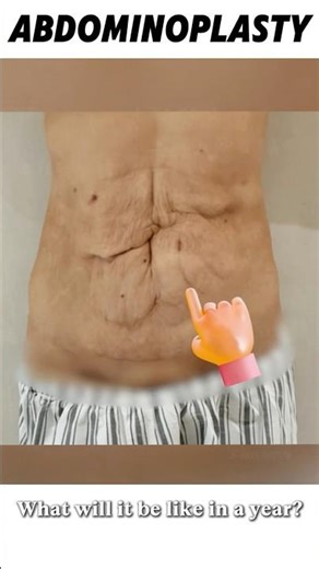 Abdominal wall shaping #腹壁成形 #軀體年輕化 #產後鬆弛 #abdominoplasty #bodyrejuvenation