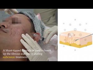 Subcision and INFINI Acne Scar Treatment | Radium Medical Aesthetics