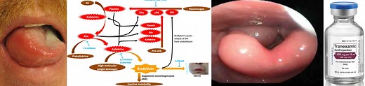 Angioedema