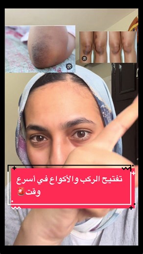 تفتيح الركب والأكواع بكريمات اقتصادية ونتيجة سريعة🚨 Save وقوليلي عندك مشكلة ايه تاني نحلها سوا؟ #skincare #تفتيح_الركب_الاكواع #pharmacy