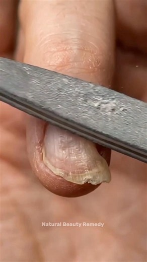 ✨ Restore your nails naturally! 💅 Healthy, shiny & stronger nails are just a few simple steps away