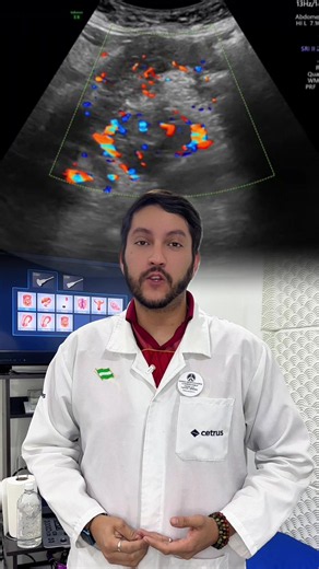 Ecografía Doppler abdominal: qué es y por qué pedirla