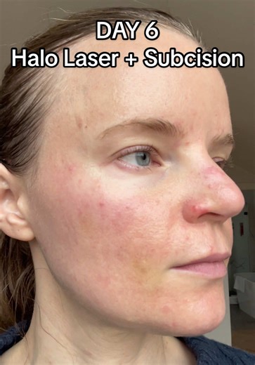 Day 6 after Halo laser subcision for rolling acne scars: - bruising still visible - pink skin - new blemishes - MENDS & scabs going away - itching has improved #halolaser #subcision #acnescars #lasertreatments #acne