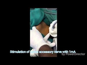 Ultrasound guided spinal accessory nerve block