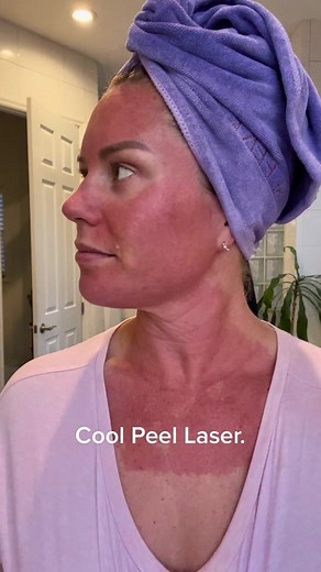 Cool Peel Laser Results Review