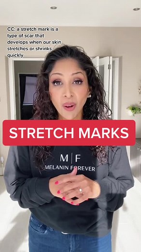 Understanding Stretch Marks: Causes, Prevention, and Treatment