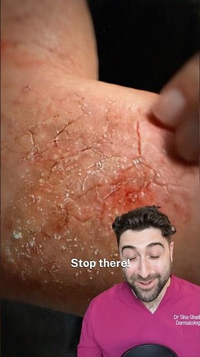 How to cure Eczema PERMANENTLY?!