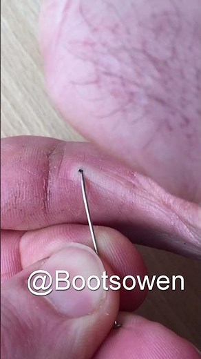 Try this one simple trick to remove a thorn from your finger: Quick and easy for splinter extraction