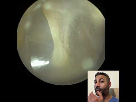 444 - Fully Blocked Ear Wax Removed Using the WAXscope®
