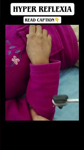 Hyperreflexia➡️exaggerated deep tendon reflexe due to loss of inhibitory control over the reflex arc