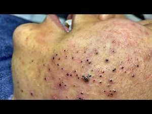 Blackhead Removal With Sac Dep Spa @100074889