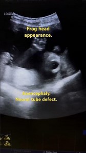 Anencephaly | Frog head Neural Tube defect #funny #ultrasound #babyultrasound #fetal
