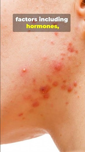 Does Coffee Actually Cause Acne? ☕😳 #acne
