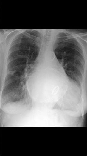 Calcified Left Atrium on Chest X-ray #shorts