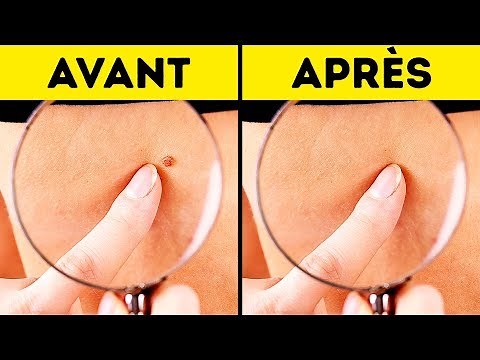 10 Manières Efficaces de se Débarrasser Naturellement Des Acrochordons