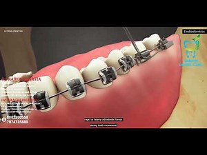 External Root Resorption (Endodontics) : Causes and Treatments by Bhartia Dental Clinic