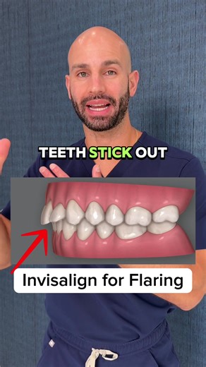 Invisalign для исправления фланцованных зубов