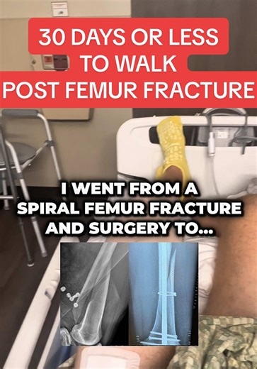 30 DAYS OR LESS TO WALK POST FEMUR FRACTURE SURGERY When I was laying in my hospital bed awaiting surgery after my femur fracture, I was scouring the internet and social media for any hope of fast recoveries I could find and to get an idea of what the timelines looked like, just like you are now. I found the results to be depressing, slow, and unacceptable. I dedicated myself to setting a faster timeline, a new standard for femur fracture recoveries, and that I did. No physical therapy, no resti