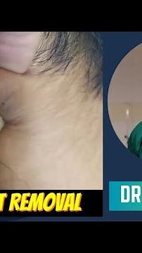 Large cyst removal by dr khaled hasan milu