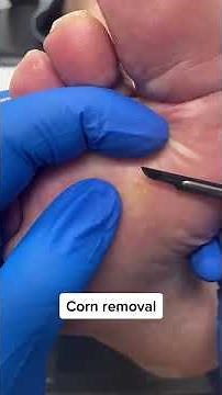 Say Goodbye to Painful Corns and Calluses Expert Australian Podiatrist Removal #FootCare #Podiatry