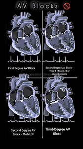 🎯📈Classification of AV Blocks: Save this guide 📌 | Share with your network! #Cardiology #ECG #HeartHealth #MedEd #AVBlocks | Abdallah Othman
