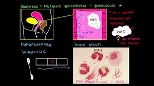 Pathophysiology, diagnosis, treatment, and prevention of gonorrhea