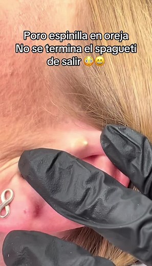 Extracciones de Granos y Espinillas en la Oreja
