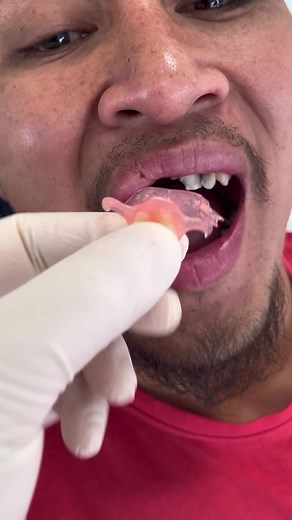 A quick temporary alternative, until patient gets full dental treatment. #fyp #foryou #foryoupage #dental #temporaryteeth #teeth #veneers