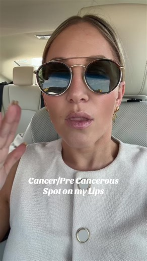 Skin Cancer Treatment Journey: Lip Spot Freezing Process