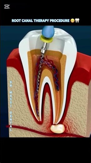 ROOT CANAL THERAPY PROCEDURE 😬🦷