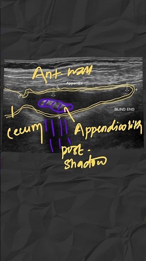 Important Appendicitis Ultrasound Features (MUST KNOW)#ultrasonography #appendicitis