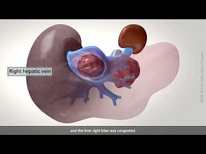 Right hepatectomy with cava resection and oophorectomy