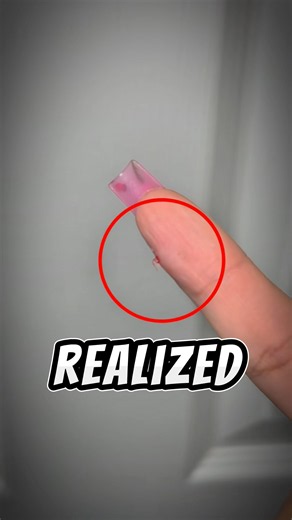 Two doctors said her finger was completely fine, 3 years later THIS popped out 😳 #shorts