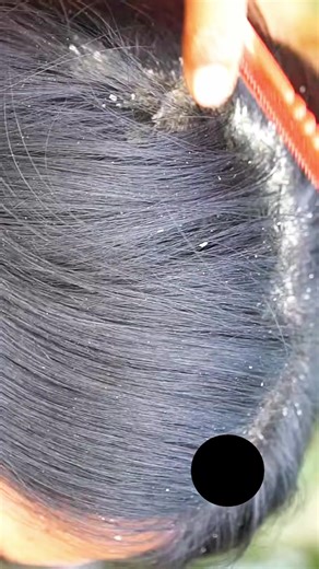 Dandruff shampoo and cleaning | dandruff shampoo