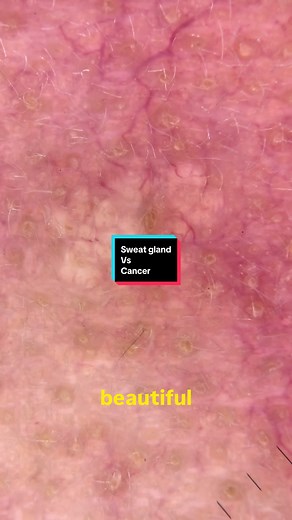 Sebaceous Hyperplasia vs Cancer: Key Differences Explained