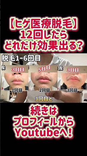 [Beard medical hair removal] What happens after 12 sessions? #shorts #beard #hairremoval #medical...