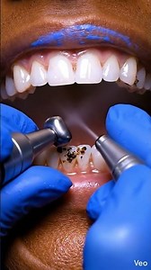 Smile Saver: Hyper-Realistic Gumline Erosion Tooth Transformation