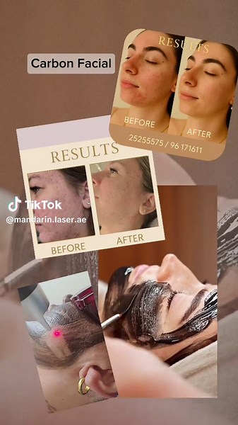 💥 Tired of acne, dark spots, or red marks? The Carbon Facial Laser is your new secret weapon for clear, smooth, glowing skin! ✨ 🌿 This advanced treatment deeply cleanses and exfoliates the skin, ⚡ reduces pigmentation, acne scars, and redness, 💧 tightens pores, and leaves your complexion bright and refreshed after every session. It’s quick, zero pain, and gives visible results from the first treatment! ✨ Say goodbye to dull, uneven skin — and hello to your natural glow! 📞 Book your session t