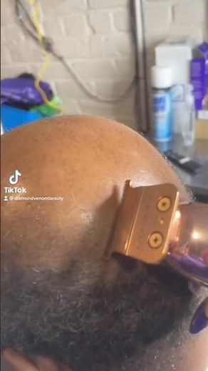 Cranial Prosthesis | Mens hair replacement