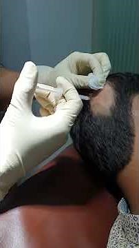 ALOPECIA AREATA = Treatment with Injection TRIAMCINOLONE ACETONIDE