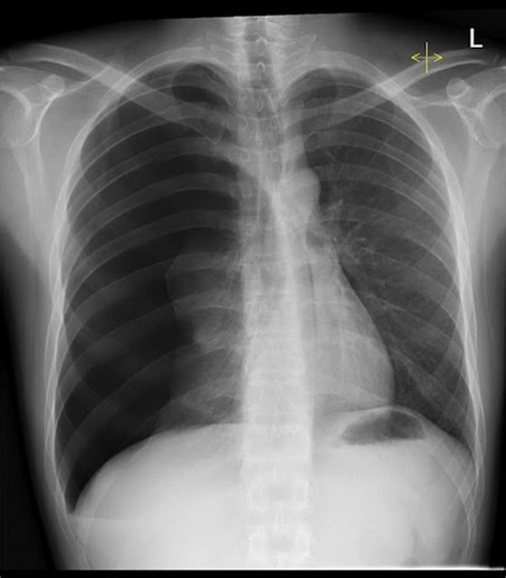 🚨 Pathology: Tension pneumothorax 🩻 What the X-ray shows • Hyperlucent hemithorax with absent lung markings • Collapsed lung margin • Depressed hemidiaphragm on the affected side • Mediastinal shift to the opposite side → indicates pressure under tension (Based on the L marker, this is a RIGHT-sided tension pneumothorax) 🫁 What’s happening Air enters the pleural space and cannot escape → rising intrathoracic pressure → lung collapse compression of heart & great vessels → ↓ venous return → obs