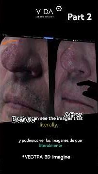 Rhinophyma 🤔 understanding the condition with Dr.De la Fuente Pt.2 ✨ #dermatologist #isotretinoina