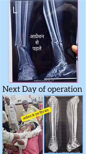 Next day of operation of tibia fibula open fracture of Padam #fracturetreatment #tibiafracture