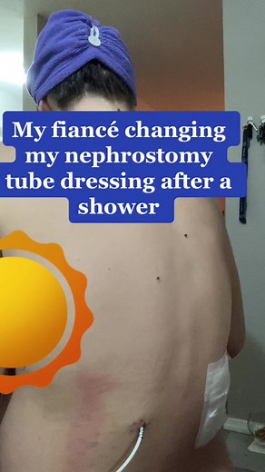 Dressing change 🩹 #woundcare #nephrostomytube #pregnancy #pregnancyco...