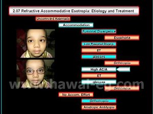 Strabismus: Refractive Accommodative Esotropia: Etiology & Treatment