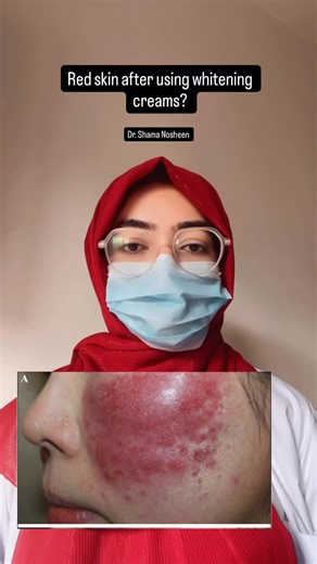 Dr. Shama Nosheen on Instagram: "Steroid-induced rosacea is a common but preventable condition caused by prolonged or unsupervised use of topical steroid-based whitening or fairness creams on the face. It presents with persistent redness, burning, flushing, visible blood vessels, acne-like bumps, and severe sensitivity. Stopping steroids abruptly can worsen symptoms, so gradual withdrawal under medical guidance is essential. Treatment focuses on barrier repair, anti-inflammatory therapy, sun pro