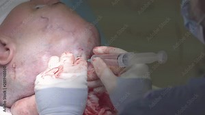 Surgeon makes an injeciton of a saline into the expander head ander the head tissues during the plastic surgery (closeup, 4K, 25fps)